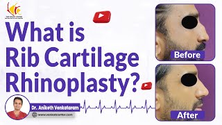 Using Rib Cartilage for Augmentation Rhinoplasty  Is it safe Venkat Center Bangalore [upl. by Medeah]