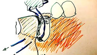 Suturing a membrane to the periostium for a one wall defect bone graft around dental implant [upl. by Audwen]