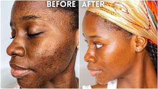 How I cleared my 8 years ACNE amp HYPERPIGMENTATION  How I got rid of textured skin amp got GLASS SKIN [upl. by Aisya149]