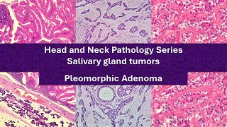 Pleomorphic Adenoma 101  highyield educational video [upl. by Ardnuhs]