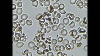 My blood is loaded with Borrelia  Many spirochetes seen in blood after 22 weeks on Doxycycline [upl. by Oir]