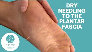 Dry Needling to the Plantar Fascia [upl. by Enorej]