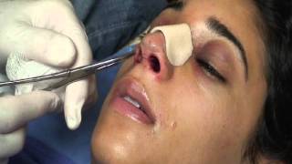 The Kotler Nasal Airway  Removal of the Airway [upl. by Rist]