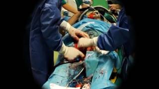 ECPR Extracorporeal CardioPulmonary Resuscitation [upl. by Enerehs]