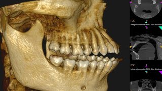 braces result for Bimaxillary Protrusionforward placed upperamplower teeth [upl. by Gris]