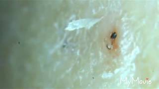 Scabs with ingrown hairs plucked out and some other gross removals [upl. by Nehemiah829]