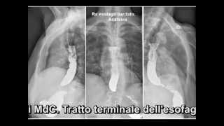 Trattamento endoscopico dellAcalasia dilatazione pneumatica [upl. by Doralyn]