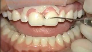 Cosmetic Dentistry  Teeth Bonding amp Dental Bonding 1 [upl. by Nosinned104]