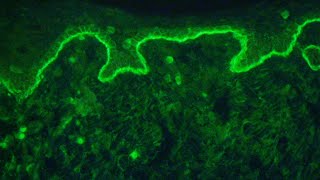 Direct immunofluorescence for autoimmune bullous diseases [upl. by Neelia]