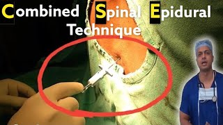 Combined Spinal Epidural Anaesthesia technique  Procedural Video from Start to End  anesthesia [upl. by Orodisi]