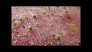 How To Removal Blackhead And How To Get Rid Of Blackhead Blackhead On Face 133 [upl. by Wirth985]