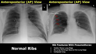 Chest XRay Ribs Normal Vs Abnormal Image Appearances  Fractures Pneumothorax Flail Chest CXR [upl. by Rahr]