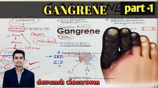 Anthracinum  Boils amp gangrene  Hindi  Dr Ketan Shah [upl. by Jurkoic726]