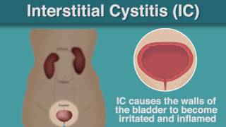 What Is  Interstitial Cystitis [upl. by Clinton]