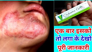 Clobeta Gm Cream Uses in Hindi  Clobenate Gm Cream Uses in hindi clobeta gm cream ke fayde [upl. by Annelise290]