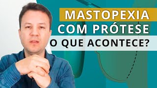 MASTOPEXIA COM PRÓTESE O que acontece após a cirurgia [upl. by Ahsekim]