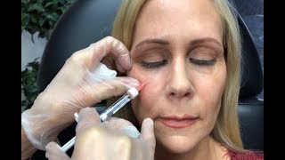 Dermal Filler Under Eyes Tear Trough Restylane and Radiesse [upl. by Joacima]