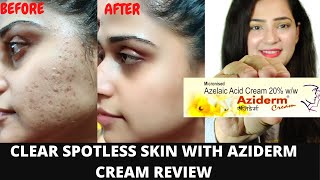 Aziderm cream  Aziderm cream review  aziderm cream 10  aziderm 10 gel  azelaic Acid  scarsmark [upl. by Lin]