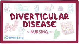 Diverticular disease Clinical Nursing Care [upl. by Ewolram]