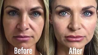 Dermal Filler Cheek Restoration Restylane Defyne [upl. by Eednak]