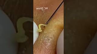 Pickel Ausdrücken Blackheads Akne amp Mitesser entfernen 🔴 47 [upl. by Barcellona]