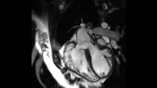 Cardiac MRI  Tetralogy of Fallot [upl. by Hynda412]