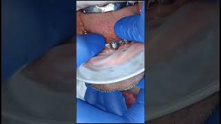 Lower full arch basal implants splinting with milled titanium bar [upl. by Seltzer]