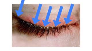 A New Treatment Approach for Blepharitis and Crusty Eyelids [upl. by Hall]