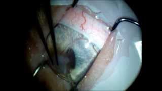 Lamelar Keratoplasty followed by a xenotransplant Frozen cornea [upl. by Ahsinar]