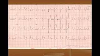 Hyperkalemia Treatment and ECG Changes [upl. by Desirea]