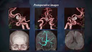 Clipping of aneurysm Anterior interhemispheric approach Acom A AN type1 [upl. by Odrude]