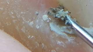 How to clean in depth lateral toenail fold 7 After beach [upl. by Namzzaj]