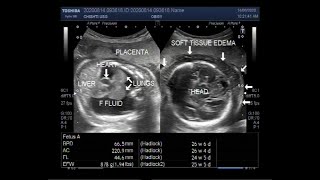 Ultrasound Video showing Hydrops fetalis Soft tissue edeme and Fetal pleural effusion [upl. by Gautea]