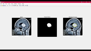 Brain Tumor Detection using Matlab  Image Processing  GUI step by step [upl. by Milka439]