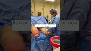 Lipedema Surgery  Liposuction for Lipedema Before amp After  Dr Boris Volshteyn [upl. by Alan]