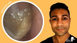 1452  Challenging Removal of BluTack Ear Wax Plug Lodged from Anterior Recess of Ear Canal [upl. by Dnalevets]