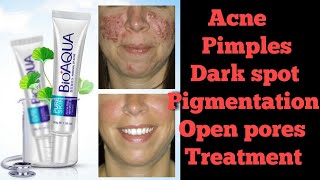 Bioaqua Cream Review  Chinese Cream  Acne  Pimples  Dark spot  Pigmentation  Open pores Cream [upl. by Ecniv]