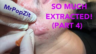 So much extracted Severe acne before and after Session 2 Comedones for days [upl. by Hatti343]