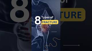 Types of bone fractureMedical Minute bones fracture bonefracture anatomy shorts medical [upl. by Asta]