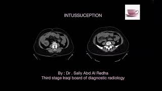 Intussusception [upl. by Nawd]