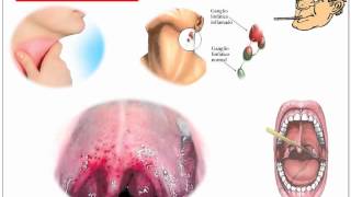 Streptococcus Pyogenes [upl. by Ecirad]