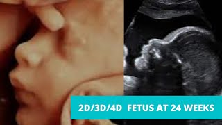 2D3D 4D Ultrasound at 24 weeks pregnancy video [upl. by Enomad]