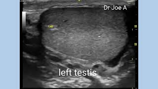 Microliths Testes or testicular microlithiasis or calcifications of Testes ultrasound video [upl. by Uria432]