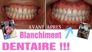 Blanchiment dentaire  AVANTAPRES Revue 25 [upl. by Elehcin]