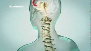 Subkutane periphere Nervenstimulation sPNS bei chronischen Rückenschmerzen [upl. by Benenson]