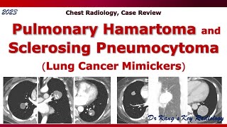 Pulmonary hamartoma amp Sclerosing pneumocytoma [upl. by Heinrich533]