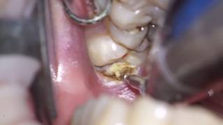 operculectomy of mn 3dr molar [upl. by Nevla]