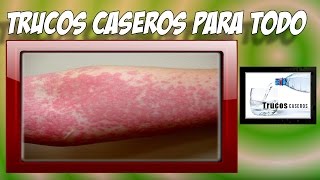 Como tratar la urticaria con remedios caseros naturales  Urticaria tratamiento natural [upl. by Jedlicka]