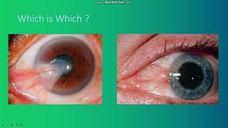 Pterygium vs Pinguecula in 4 mins [upl. by Mariann497]