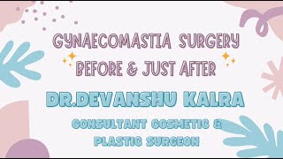 GYNAECOMASTIA TREATMENT I DR DEVANSHU KALRA I DR KALRAS CLINIC KARNAL I BEST PLASTIC SURGEON KARNAL [upl. by Roel159]